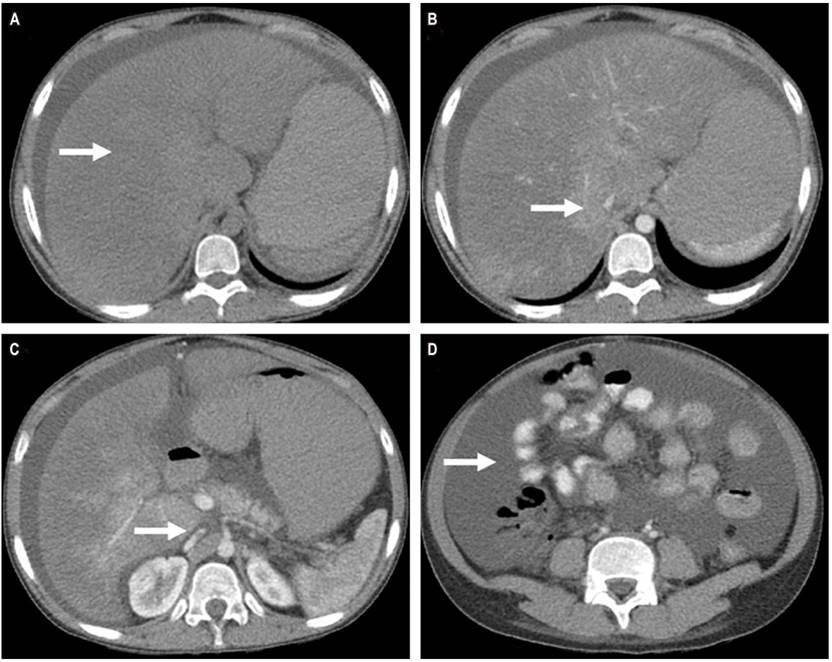Tomograf&iacute;a de abdomen y pelvis. A. Fase sin contraste, hepatomegalia. B. Fase contrastada, ausencia de flujo en vena suprahep&aacute;ticas. C. Fase contrastada, compresi&oacute;n de la vena cava inferior. D. Fase contrastada, ascitis.