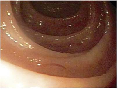 EVDA en la que se evidencia uncinariasis duodenal.