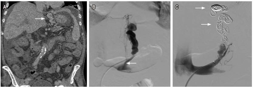 Hombre de 74 años. Cirrosis, várices gástricas con shunt gastrorrenal. A. Tomografía abdominal contrastada, corte coronal con ventana a tejidos blandos que muestra várices tortuosas adyacentes a la curvatura menor del estómago (flecha). B. Venografía selectiva opacificando várices tortuosas en curvatura menor, con algunas venas drenaje paraespinales y shunt gastrorrenal (flecha). C. Embolización con coils (flecha) ocluyendo el flujo en várices.