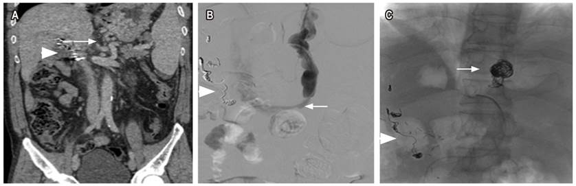 Hombre de 60 años, antecedente de pancreatoduodenectomía, quien desarrolló pseudoaneurisma de arteria hepática, embolizado con coils (triángulo A, B y C) con várices gástricas y shunt gastrorrenal. A. Tomografía abdominal contrastada, corte coronal con ventana a tejidos blandos que muestra várices tortuosas en una curvatura menor del estómago (flecha). B. Venografía selectiva opacificando las várices tortuosas en una curvatura menor y shunt gastrorrenal (flecha). C. Embolización con coils (flecha) ocluyendo el flujo en várices.