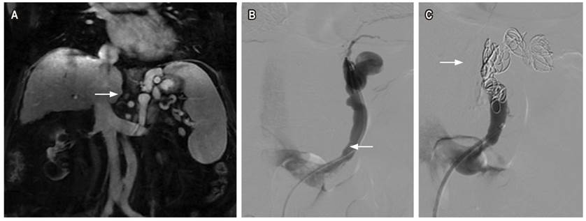 Mujer de 66 años con cirrosis hepática. A. Resonancia magnética abdominal contrastada, corte coronal T1 con saturación grasa, várices tortuosas adyacentes a la curvatura menor del estómago y shunt gastrorrenal (flecha). B. Venografía selectiva opacificando várice tortuosa en una curvatura menor y shunt gastrorrenal (flecha). C. Embolización con coils (flecha) ocluyendo el flujo en várices.
