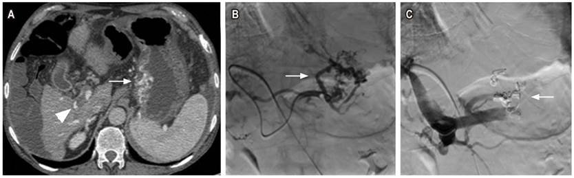 Mujer de 66 años con cirrosis hepática no candidata para TIPS por trombosis de la porta (triángulo A). A. Tomografía abdominal contrastada, corte axial con ventana a tejidos blandos, várices tortuosas adyacentes a la curvatura menor del estómago (flecha). B. Venografía selectiva de acceso retrógrado portal opacificando várices tortuosas en la curvatura menor gástrica (flecha). C. Embolización con coils (flecha) ocluyendo el flujo en várices.