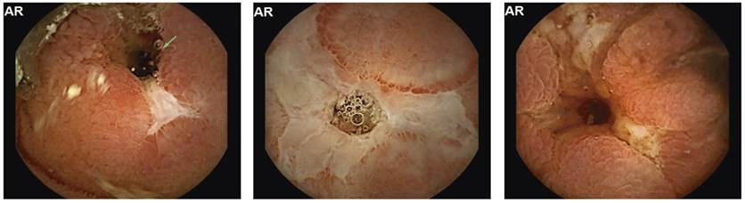 Videoc&aacute;psula endosc&oacute;pica. Estenosis ulcerada conc&eacute;ntrica, rodeada de mucosa edematizada.