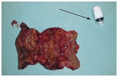 Pieza quir&uacute;rgica. Segmento esten&oacute;tico de 6,5 cm de intestino delgado (&iacute;leon). Videoc&aacute;psula endosc&oacute;pica (flecha).