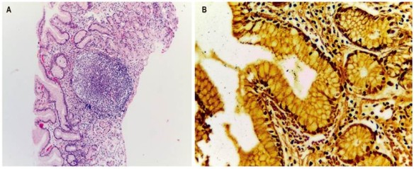 A.H. pylori en la coloraci&oacute;n rutinaria de HE 4x, Se observan agregados linfoides con centros germinales activos. Los agregados est&aacute;n rodeados por un proceso inflamatorio linfoplasmocitario. B.H. pylori en la coloraci&oacute;n especial de WS 40x. Se observa en la luz de algunas gl&aacute;ndulas que se destacan escasos bacilos espirales negros, los cuales corresponden a bacilos H. pylori.