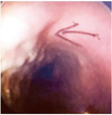 Caso 2: várice proximal