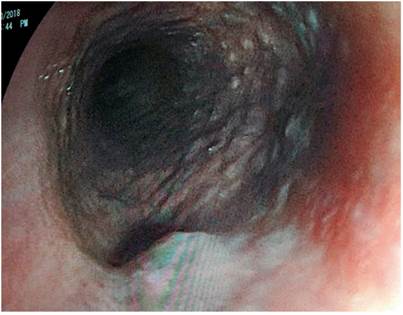 Caso 21: várice proximal