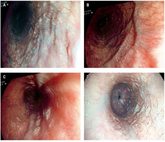 Caso 21. A. Várices proximales. B y C. Várices en el tercio medio. D. Ausencia de várices en el tercio distal