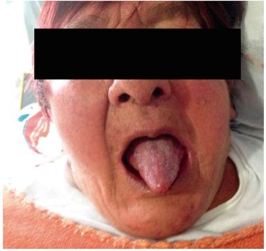 Caso 3: cianosis severa de piel y mucosas y abotagamiento