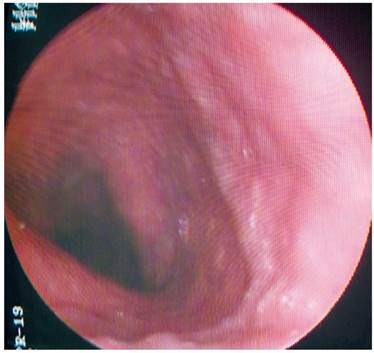 Caso 3: dilatación venosa esófago proximal