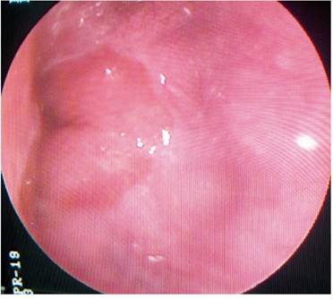 Caso 3: esófago distal normal, sin dilataciones venosas