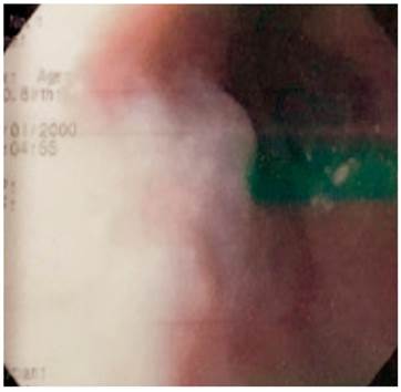Caso 8: várices proximales