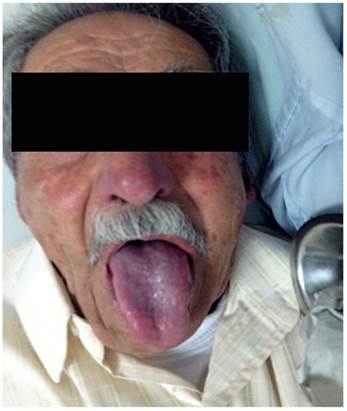 Caso 9: cianosis severa en la piel y mucosas, abotagamiento