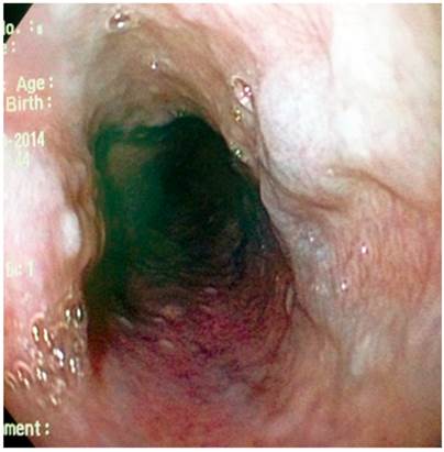 Caso 9: várice esofágica en el esófago proximal