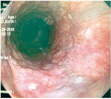 Caso 9: várice proximal que no se extiende al esófago medio.