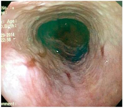 Caso 9: esófago distal sin várices y con esofagitis péptica erosiva grado B