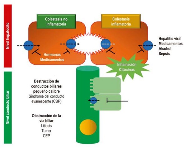 Mecanismos principales de la colestasis. CBP: colangitis biliar primaria; CEP: colangitis esclerosante primaria. Tomada de la referencia 5.