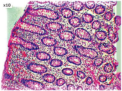 Infiltraci&oacute;n eosinof&iacute;lica de la l&aacute;mina propia. Imagen por cortes&iacute;a del Dr. Jorge Monroy, jefe de Patolog&iacute;a del Hospital Central de la Polic&iacute;a