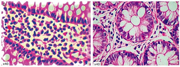 A. En l&aacute;mina propia se observa un denso infiltrado inflamatorio mononuclear, con una abundante presencia de eosin&oacute;filos. B. Epitelio permeado por eosin&oacute;filos. Im&aacute;genes por cortes&iacute;a del Dr. Jorge Monroy, jefe de Patolog&iacute;a del Hospital Central de la Polic&iacute;a.
