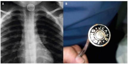 A. Radiografía posteroanterior de tórax que muestra un cuerpo extraño radiopaco y redondeado en el tercio superior del esófago, con un doble contorno. B. Botón metálico de pantalón extraído con una sonda de Foley.