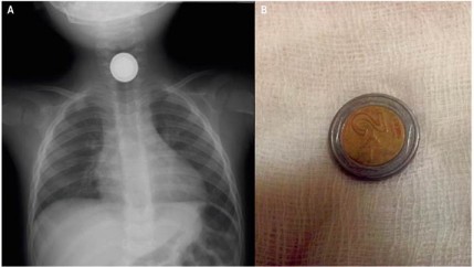 A. Radiografía anteroposterior de tórax que muestra un cuerpo extraño radiopaco y redondeado en el tercio superior del esófago, con doble contorno. B. Moneda extraída que corresponde a dos nuevos soles peruanos, los cuales contienen doble aleación y provocan una doble densidad en la radiografía frontal.
