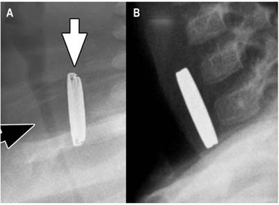 A. Radiografía lateral que muestra claramente la diferencia de diámetro entre el cátodo y el ánodo (flecha blanca), así como las diferentes densidades correspondientes a las distintas aleaciones que se encuentran en las pilas de botón (flecha negra). B) Radiografía lateral de un paciente con ingesta de doble moneda, las cuales se hallan adosadas entre sí, por lo que muestran un borde lateral uniforme y una sola densidad radiológica.