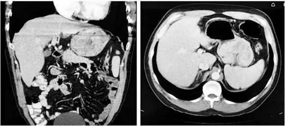 Tomograf&iacute;a axial computarizada (TAC) abdominal que evidencia la masa g&aacute;strica. Cortes coronal y axial