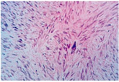 Tinci&oacute;n de hematoxilina-eosina. C&eacute;lulas fusiformes con n&uacute;cleo at&iacute;pico