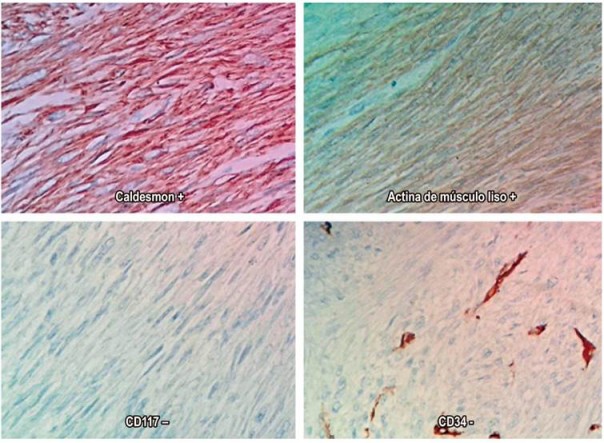 Inmunohistoqu&iacute;mica positiva para actina del m&uacute;sculo liso y caldesmona, negativo para CD117 y CD34