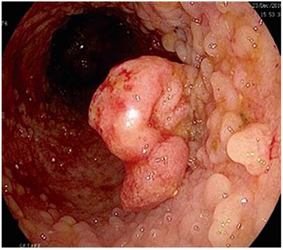 Un p&oacute;lipo s&eacute;sil de 15 mm (0-Is de la clasificaci&oacute;n de Par&iacute;s) en el colon ascendente