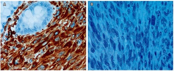 A. La inmunohistoqu&iacute;mica fue positiva para la vimentina. B. La inmunohistoqu&iacute;mica fue negativa para el c-kit y el CD34