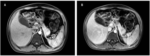 A. RMN abdominal contrastada. Lesión sólida de 22 mm en la cola del páncreas, con realce posterior; administración de contraste endovenoso. Páncreas de tamaño normal. B. Lesión sólida de 22 mm en la cola del páncreas, hipointensa en T1, isointensa en T2, hiperintensa en difusión, con realce posterior a la administración de contraste endovenoso
