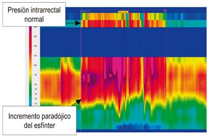 Disinergia defecatoria tipo 1