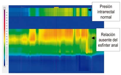 Disinergia defecatoria tipo 3