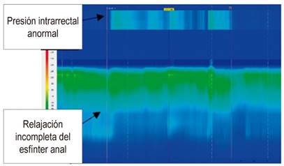 Disinergia defecatoria tipo 4
