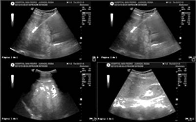 Ecograf&iacute;a de h&iacute;gado y v&iacute;as biliares. M&uacute;ltiples lesiones focales de posible origen metast&aacute;sico