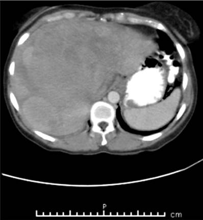 TAC de abdomen contrastado. H&iacute;gado con ecogenicidad heterog&eacute;nea, en el que se observa 3 lesiones de predominio isodenso, con algunas &aacute;reas de menor densidad al interior, localizadas en los segmentos 5, 7 y 8 y otras 2 lesiones hacia los segmentos 2 y 7
