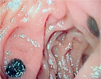 Endoscopia de v&iacute;as digestivas altas. Duodeno segunda porci&oacute;n. Se observa en el bulbo 2 lesiones hiperpigmentadas de 5 mm.