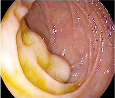 Dos lesiones de aspecto subepitelial recubiertas de mucosa normal inmediatamente distales a la papila duodenal