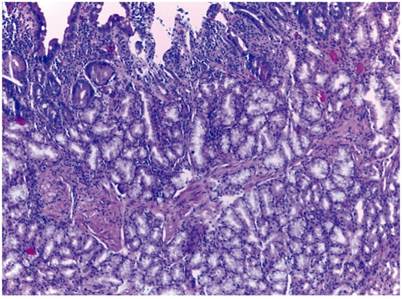 En la mucosa se observa una altura vellositaria correcta y l&oacute;bulos de gl&aacute;ndulas de Brunner en m&aacute;s de la mitad de la misma. Estos l&oacute;bulos se contin&uacute;an con abundantes gl&aacute;ndulas de Brunner a nivel submucoso. Las c&eacute;lulas muestran el t&iacute;pico citoplasma claro mucoso, sin observarse atipia citol&oacute;gica (H&E x400)
