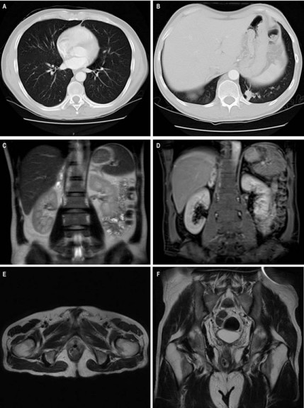Im&aacute;genes del paciente al momento del diagn&oacute;stico. A y B. TAC de t&oacute;rax. Proyecci&oacute;n axial. M&uacute;ltiples n&oacute;dulos subcentim&eacute;tricos con densidad de tejidos blandos de distribuci&oacute;n aleatoria y una lesi&oacute;n nodular dominante en la base pulmonar izquierda. C y D. RM de abdomen. Proyecci&oacute;n coronal. Se evidencian dos lesiones focales en la gl&aacute;ndula suprarrenal derecha: una de ellas en el brazo medial de 14 x 17 mm y otra en el cuerpo de la gl&aacute;ndula de 14 x 19 mm, las cuales son hiperintensas en T2 (C) e hipointensas en T1 (D), no suprimen se&ntilde;al en secuencias fuera de fase, presentan restricci&oacute;n perif&eacute;rica a la difusi&oacute;n y realce perif&eacute;rico al medio de contraste en relaci&oacute;n con met&aacute;stasis necr&oacute;ticas (estas dos &uacute;ltimas secuencias no ilustradas). E y F. RM de pelvis. Proyecciones axial y coronal en secuencia T2. Se evidencia engrosamiento conc&eacute;ntrico y de aspecto neopl&aacute;sico con zona de ulceraci&oacute;n anterior en el canal anal, con espesor de 14 mm y presencia de realce moderado con el medio de contraste en contacto con la uretra membranosa, sin f&iacute;stulas a este &oacute;rgano.