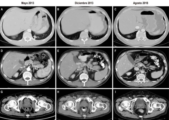 Seguimiento tomogr&aacute;fico del paciente. A-C. Las im&aacute;genes muestran la evoluci&oacute;n del tama&ntilde;o del n&oacute;dulo metast&aacute;sico en la base del pulm&oacute;n izquierdo, con resoluci&oacute;n completa a fecha del &uacute;ltimo seguimiento. D-F. Se evidencia la evoluci&oacute;n de una de las lesiones metast&aacute;sicas en la gl&aacute;ndula suprarrenal derecha, con respuesta completa en el &uacute;ltimo estudio. G-I. Las im&aacute;genes muestran la respuesta parcial a nivel del canal anal, con enfermedad estable a agosto de 2018.