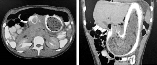 TAC de abdomen con doble contraste.