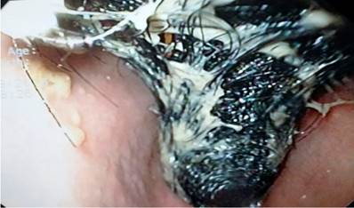 Endoscopia de las v&iacute;as digestivas altas. Se observa abundante cabello, proveniente del est&oacute;mago, el cual impide el paso del equipo.