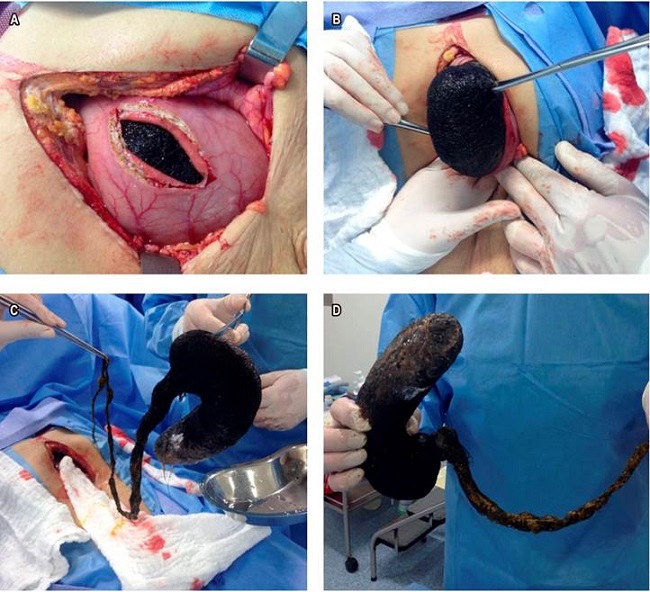 Extracci&oacute;n quir&uacute;rgica del tricobezoar (A, B y C). Pieza quir&uacute;rgica del tricobezoar, amoldado a la forma del est&oacute;mago y el intestino delgado (D).