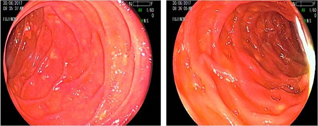 Im&aacute;genes de EVDEA que muestran m&uacute;ltiples inclusiones amarillentas, submucosas de aproximadamente 3 mm, localizadas en el duodeno.
