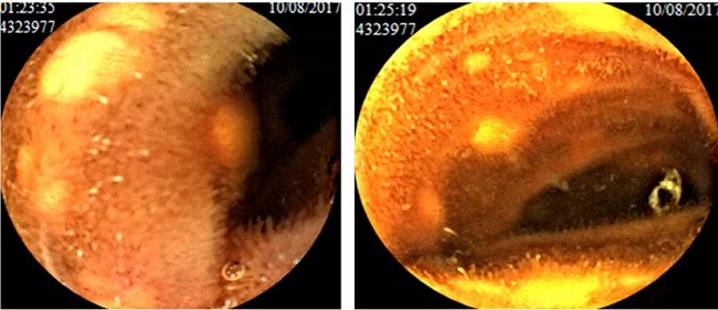 Im&aacute;genes de videoc&aacute;psula endosc&oacute;pica en las cuales se identifican m&uacute;ltiples lesiones amarillentas, redondeadas, de diferente tama&ntilde;o y de aspecto benigno en el intestino delgado.