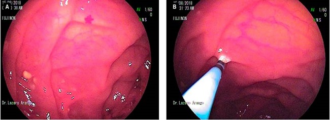 A. Lesiones lipomatosas del yeyuno y una angiodisplasia al lado. B. Terapia con arg&oacute;n plasma de la lesi&oacute;n lipomatosa ulcerada y de la angiodisplasia. Im&aacute;genes tomadas por el Dr. L&aacute;zaro Arango.