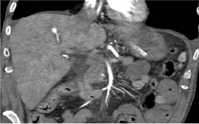 Aneurisma de una rama segmentaria de la arteria hep&aacute;tica derecha, en el segmento V.