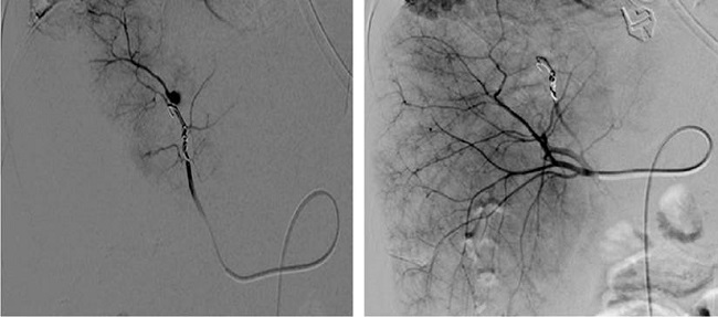 Arteriograf&iacute;a hep&aacute;tica y embolizaci&oacute;n del aneurisma de la arteria hep&aacute;tica.